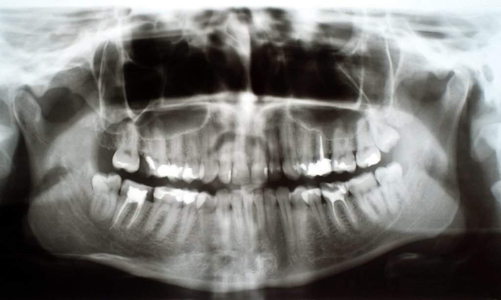 x-ray of teeth