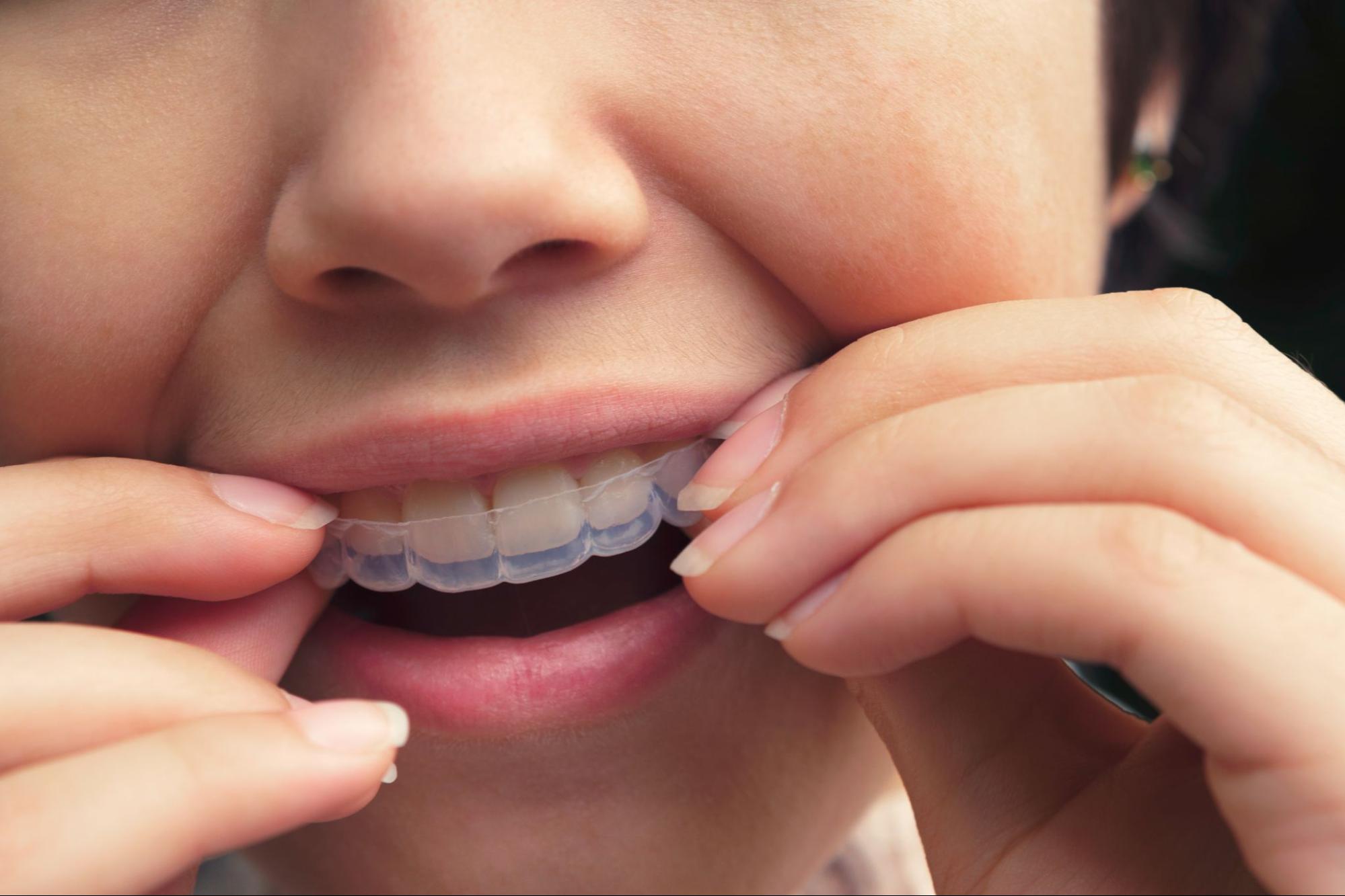 Tips for Wearing Clear Aligners While in School