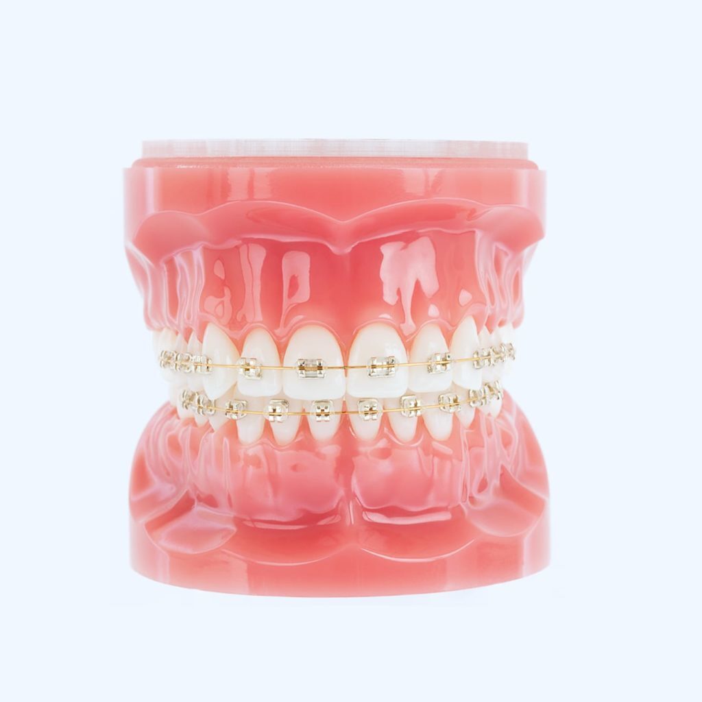Champagne-colored gold orthodontic braces on a model of teeth.